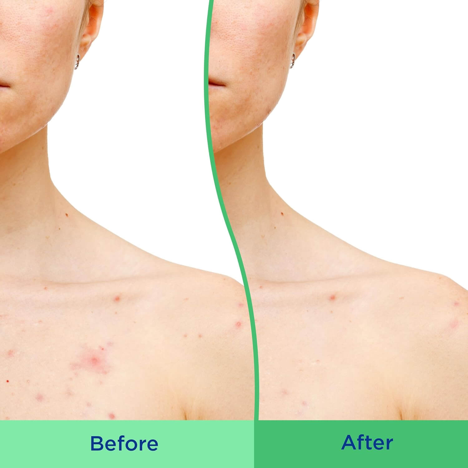 Acne-Clearing Body Scrub  - image 4