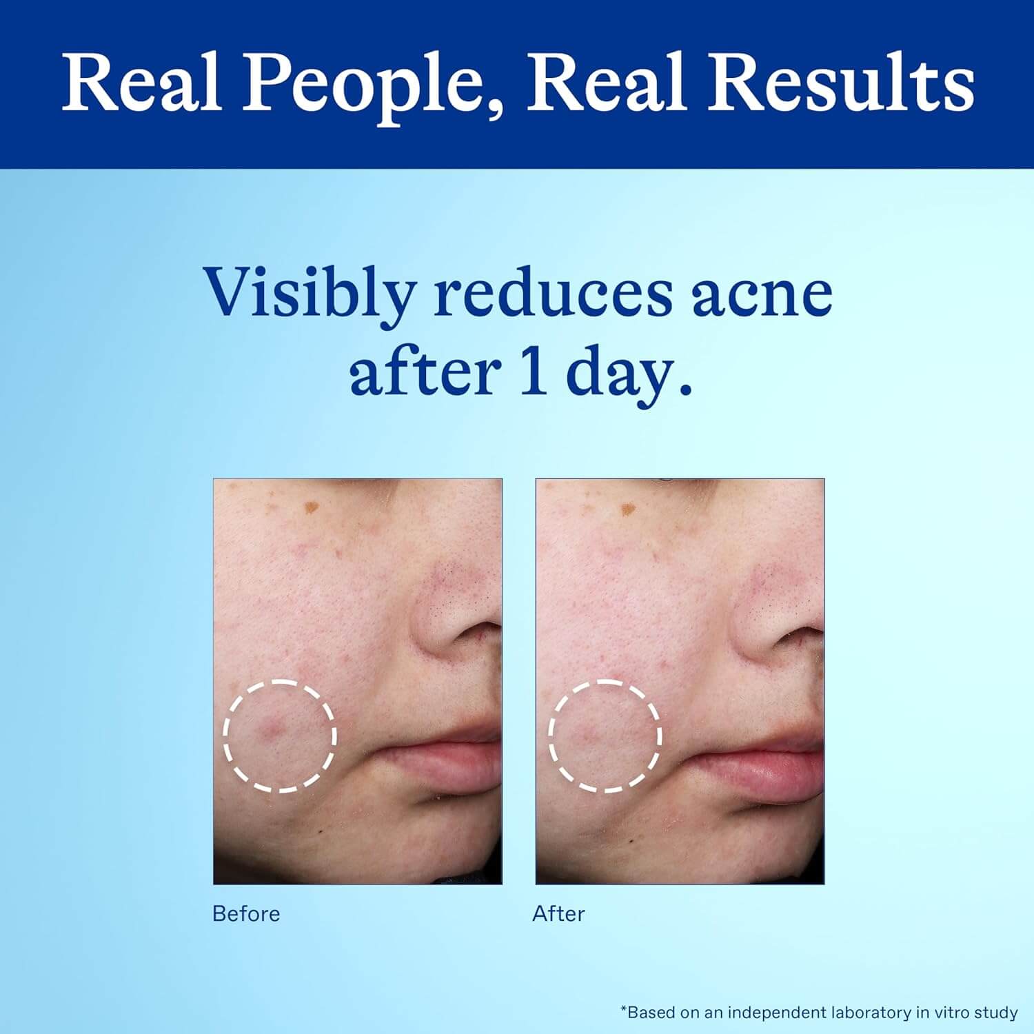 10% Benzoyl Peroxide Spot Treatment - image 5