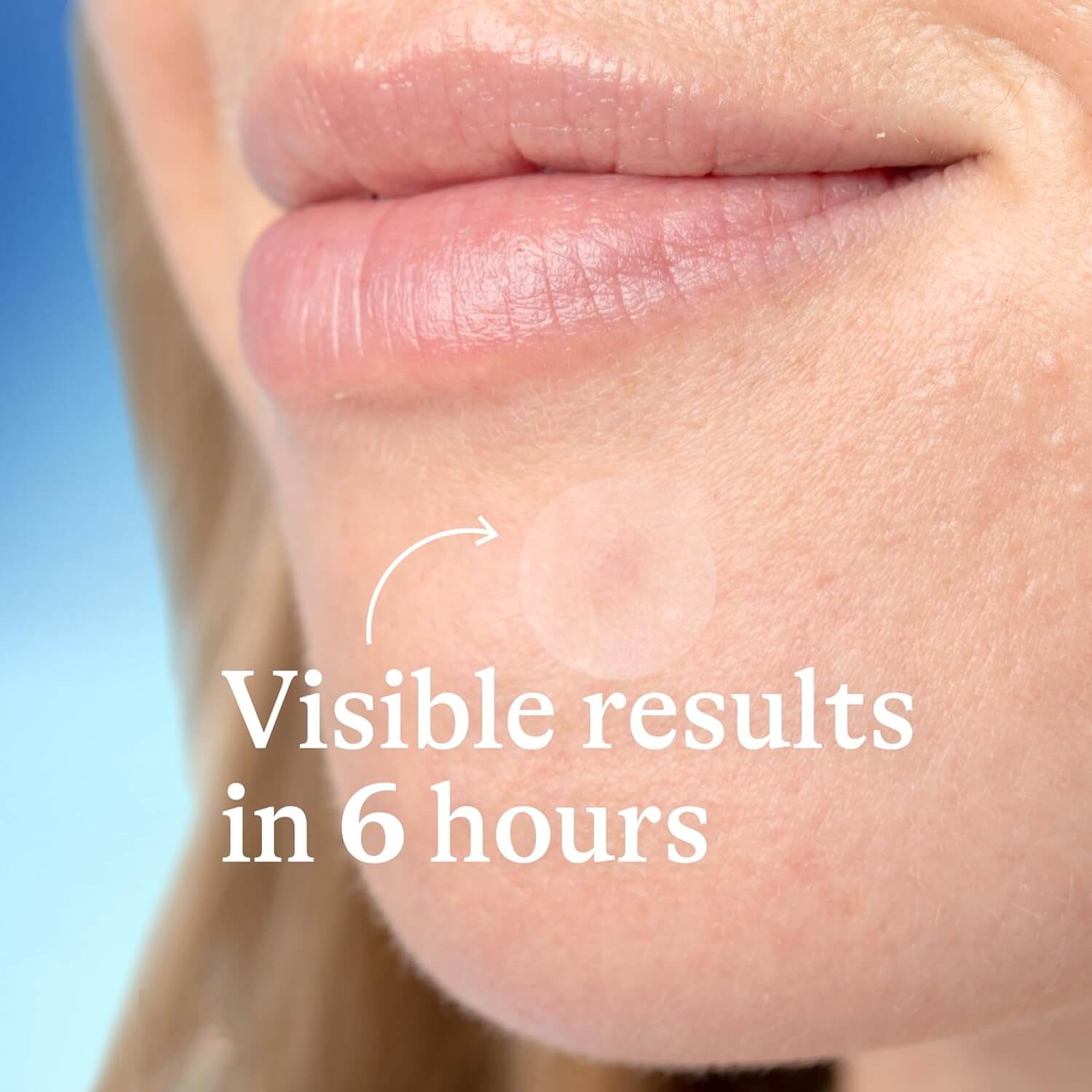 Salicylic Acid Acne-Prone Skin Patches  - image 3