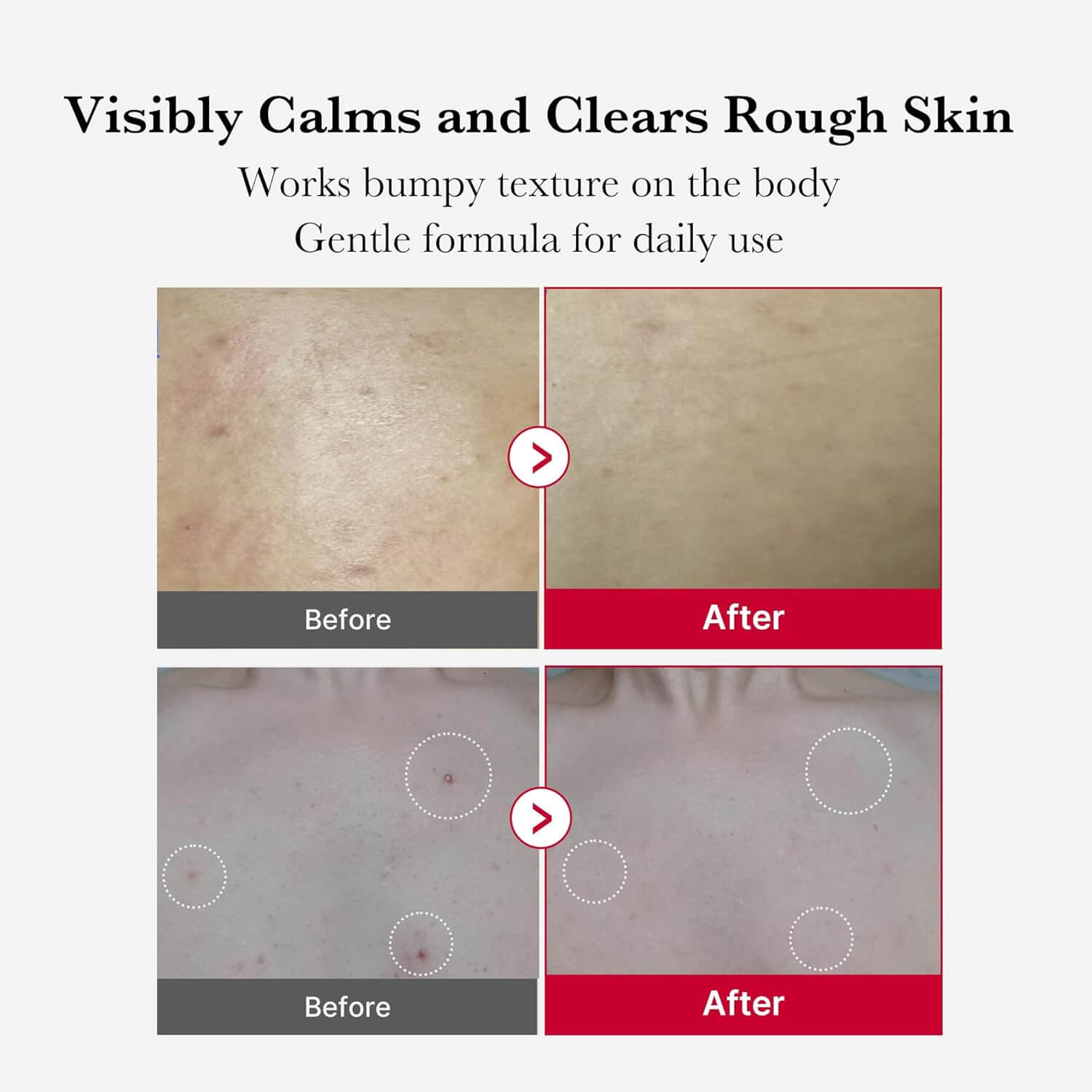 Red Acne Body Peeling Shot - image 5