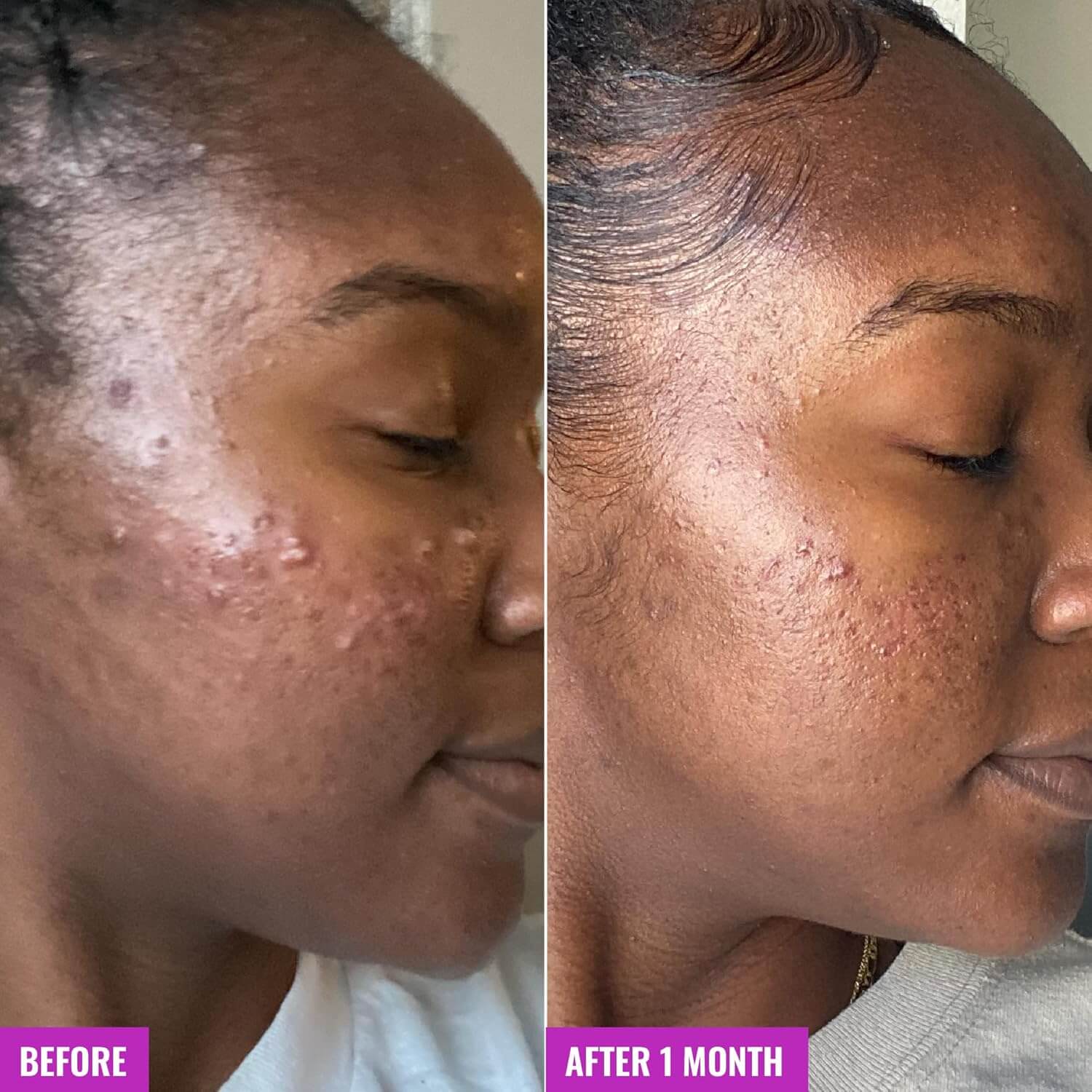 Acne Foaming Cleanser - image 4