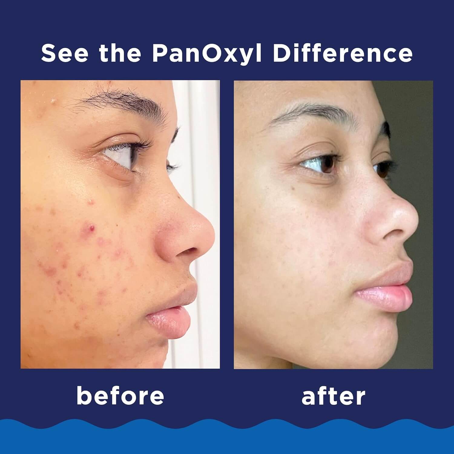 Acne Foaming Wash Benzoyl Peroxide 10% Maximum Strength - image 6
