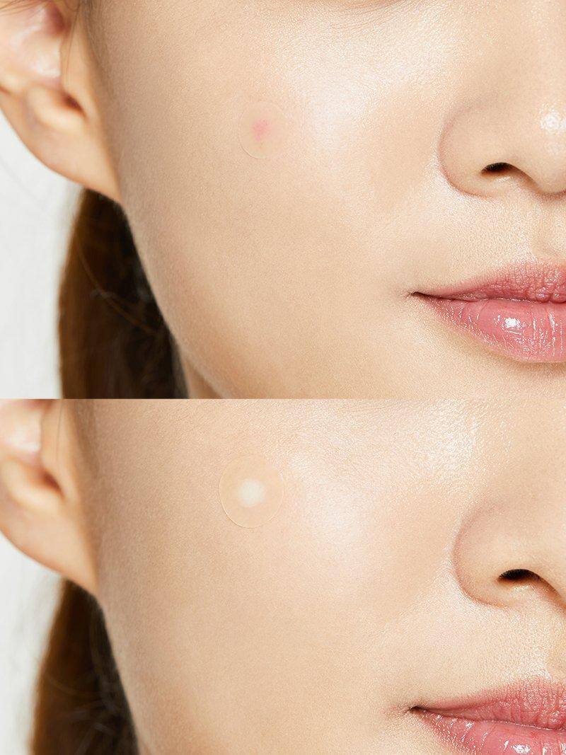 Acne Pimple Master Patch - image 5