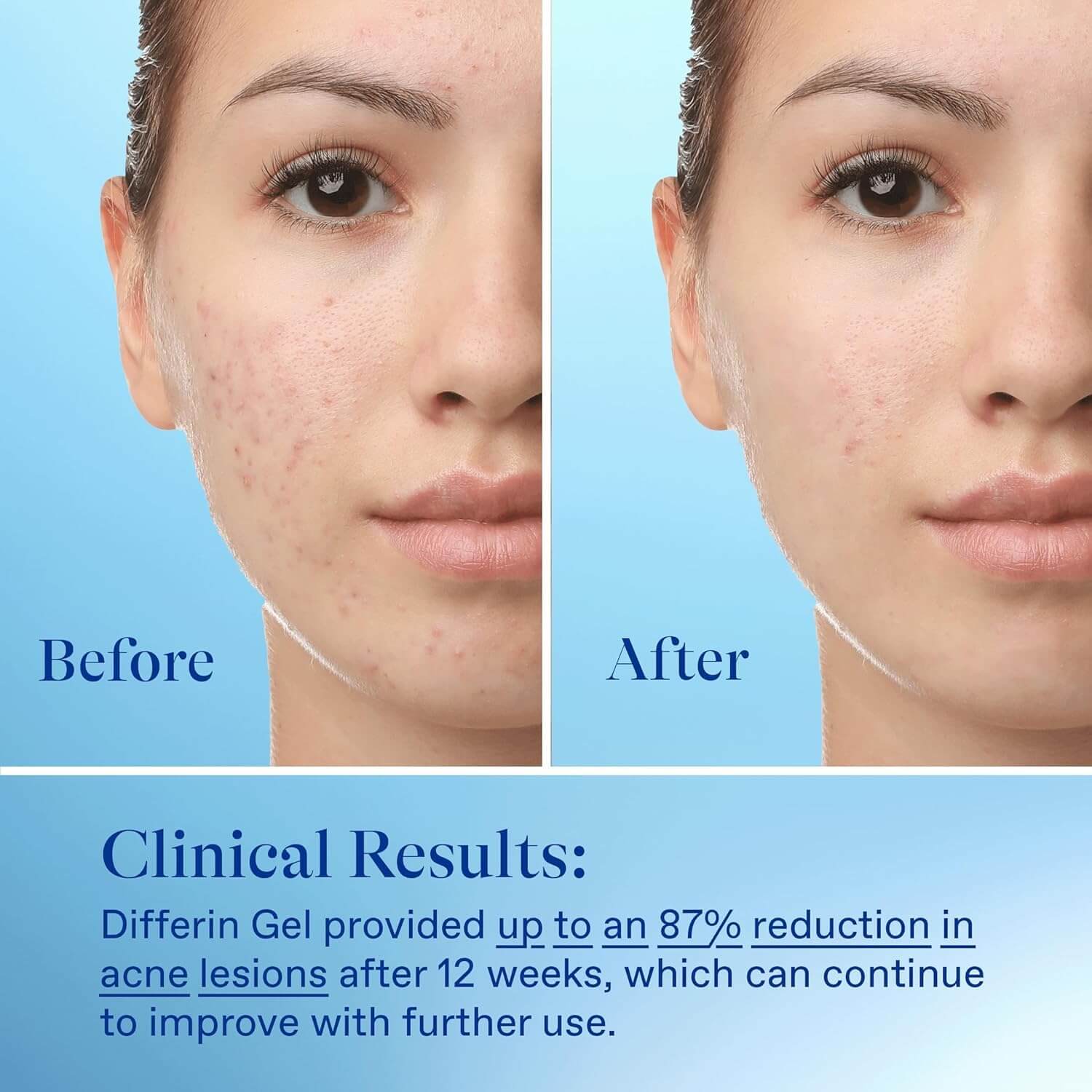 Differin Gel - Adapalene Gel 0.1% Acne Treatment - image 7