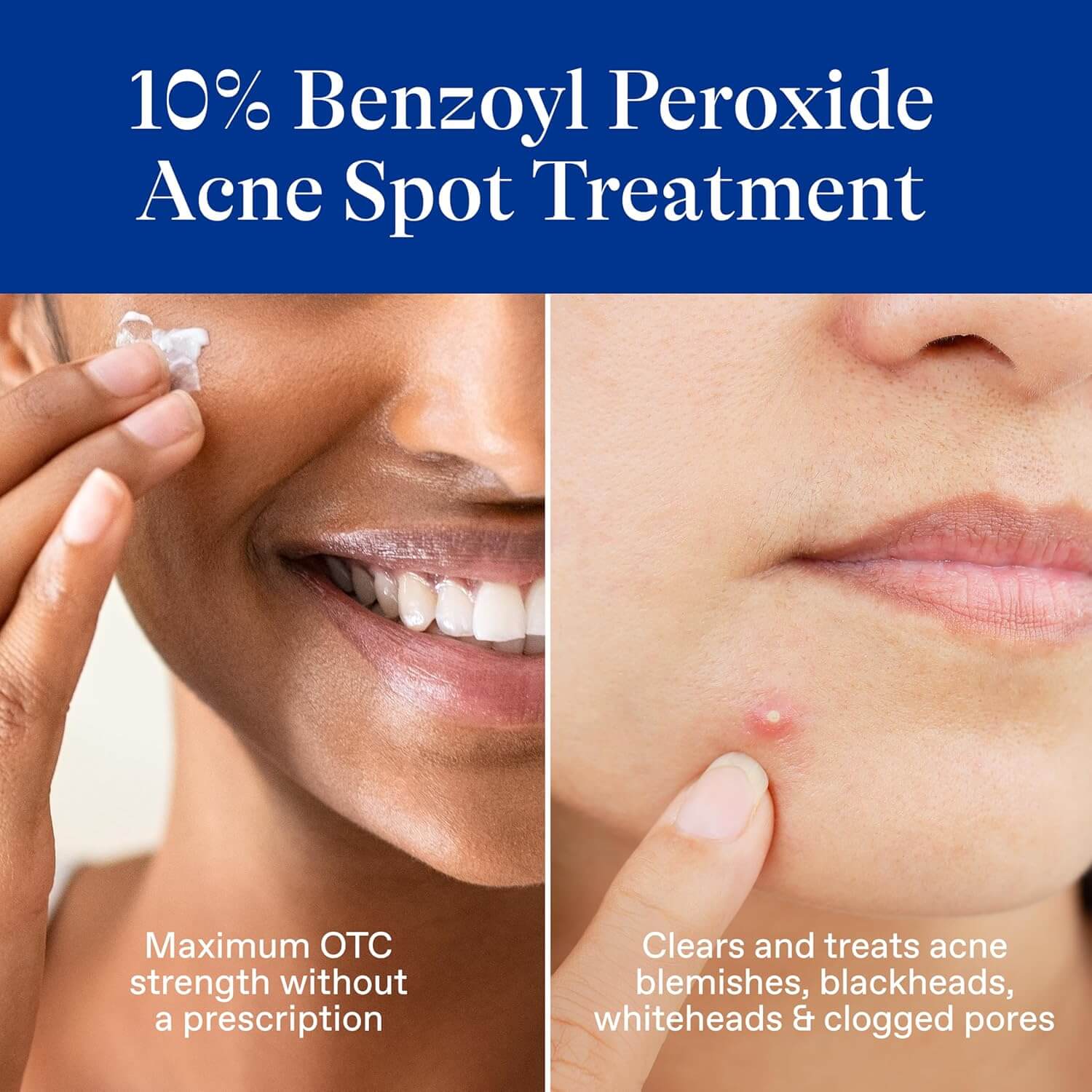 10% Benzoyl Peroxide Spot Treatment - image 3