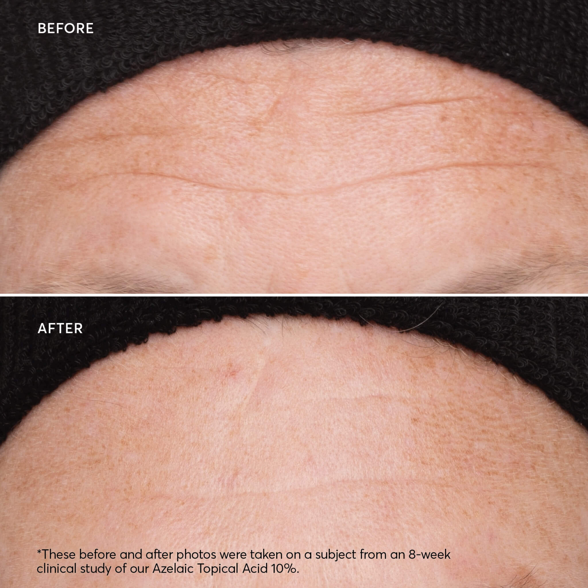 Azelaic Topical Acid 10% - image 10
