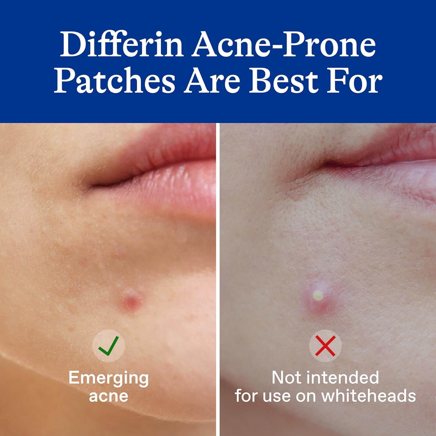 Salicylic Acid Acne-Prone Skin Patches  - image 5